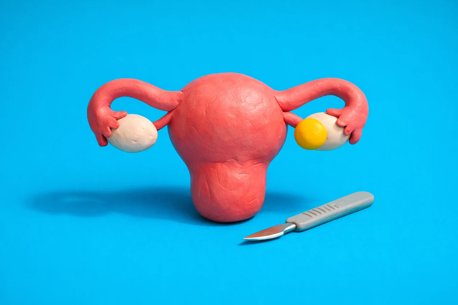 Do I Need A Hysterectomy - claymation artwork